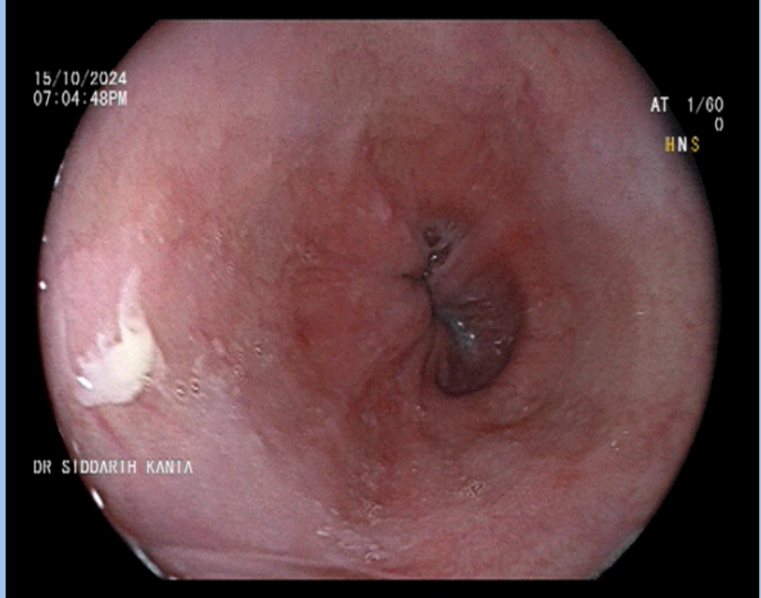 Upper GI Endoscopy